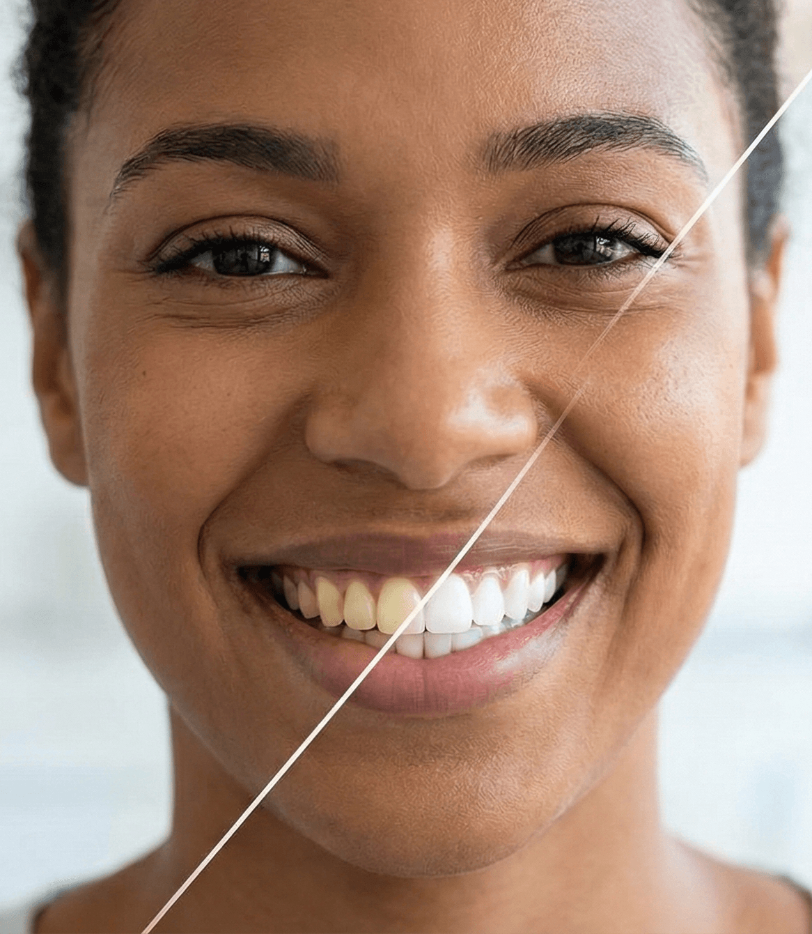 Professional teeth whitening treatment in a dental office